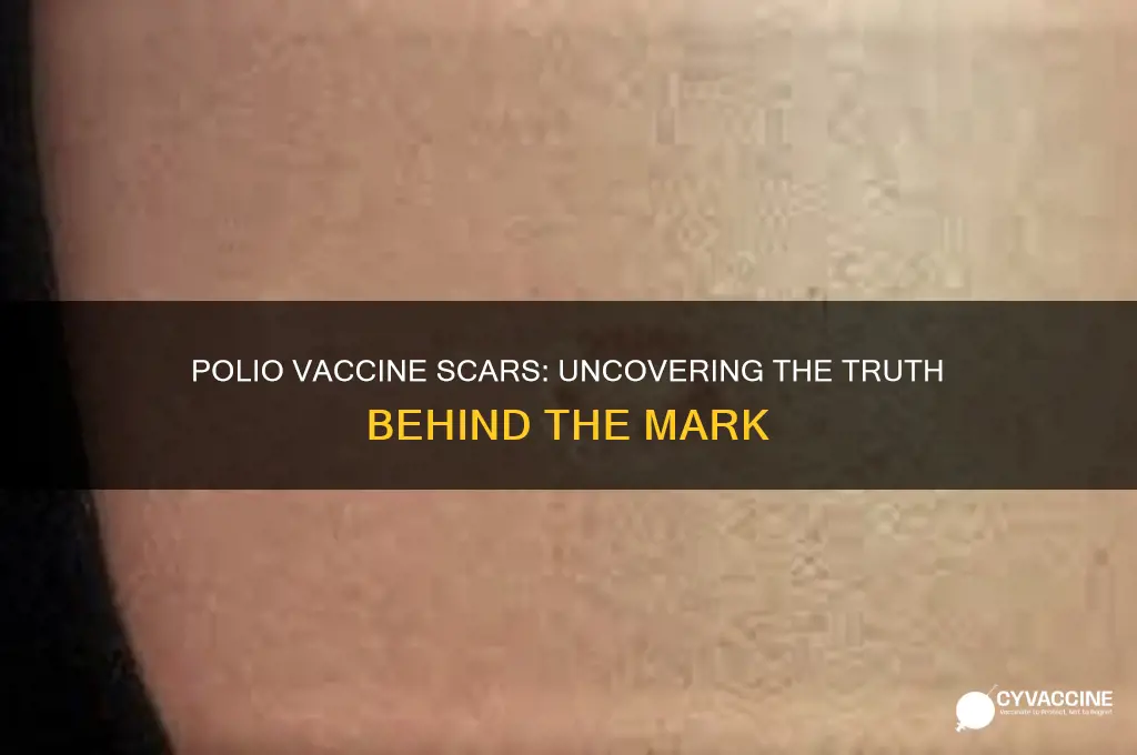 did polio vaccine leave a scar