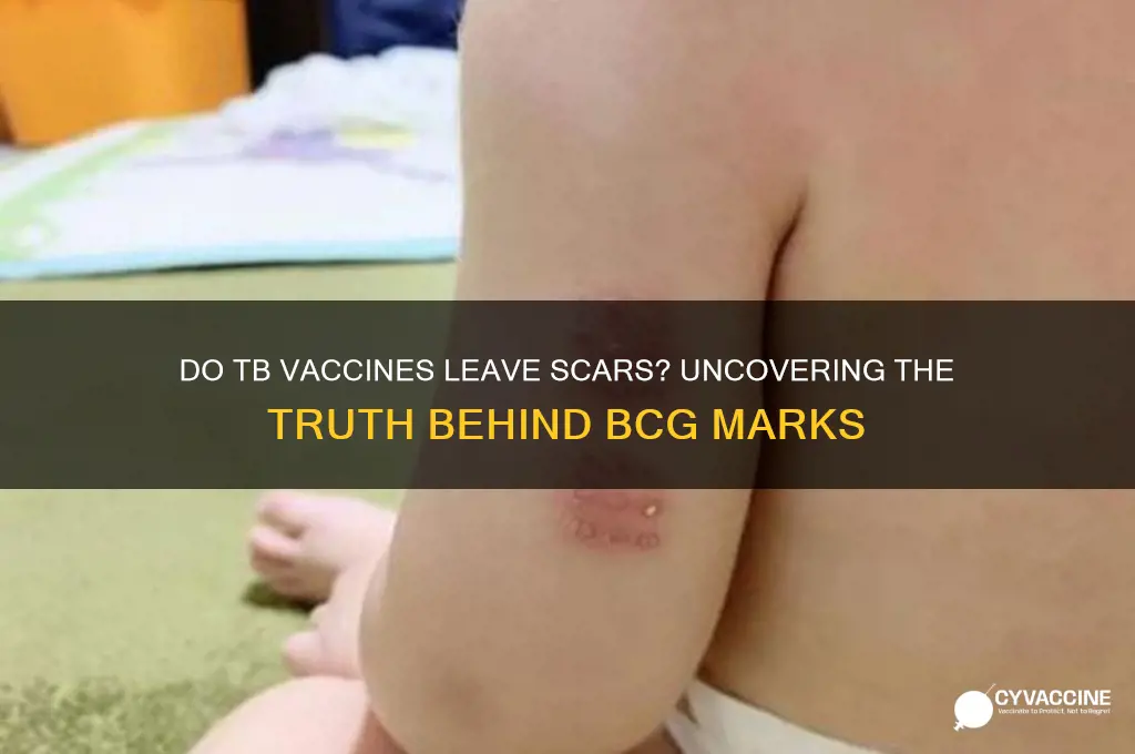 did tb vaccines leave a scar