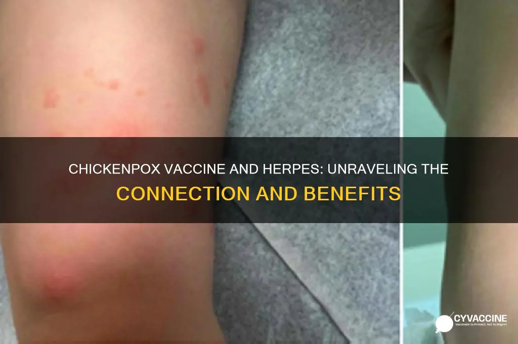 does chicken pox vaccine help herpes