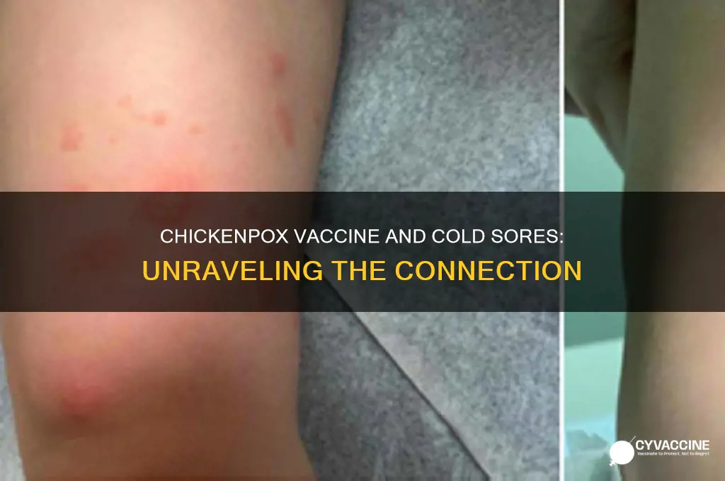does chickenpox vaccine prevent cold sores