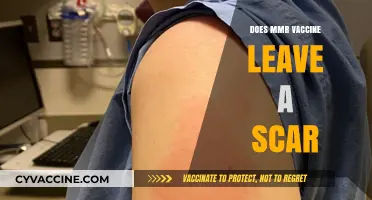 MMR Vaccine and Scars: What You Need to Know