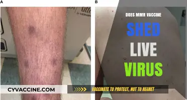 MMR Vaccine Shedding: Separating Fact from Fiction About Live Virus Concerns