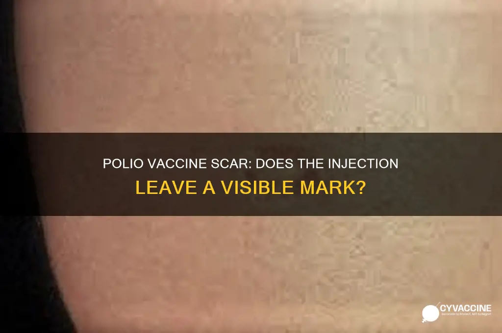 does polio vaccine leave a mark