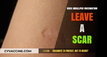 Smallpox Vaccination Scars: Causes, Appearance, and Long-Term Effects Explained