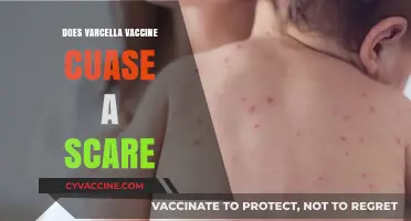 Does the Varicella Vaccine Cause Unfounded Scare or Real Concern?