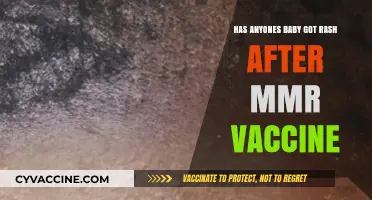 MMR Vaccine and Baby Rashes: What Parents Need to Know