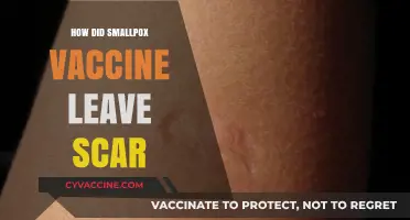 Smallpox Vaccine Scars: Understanding the Mark of Immunity