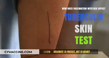 BCG Vaccination Impact: How It Alters Tuberculin Skin Test Results