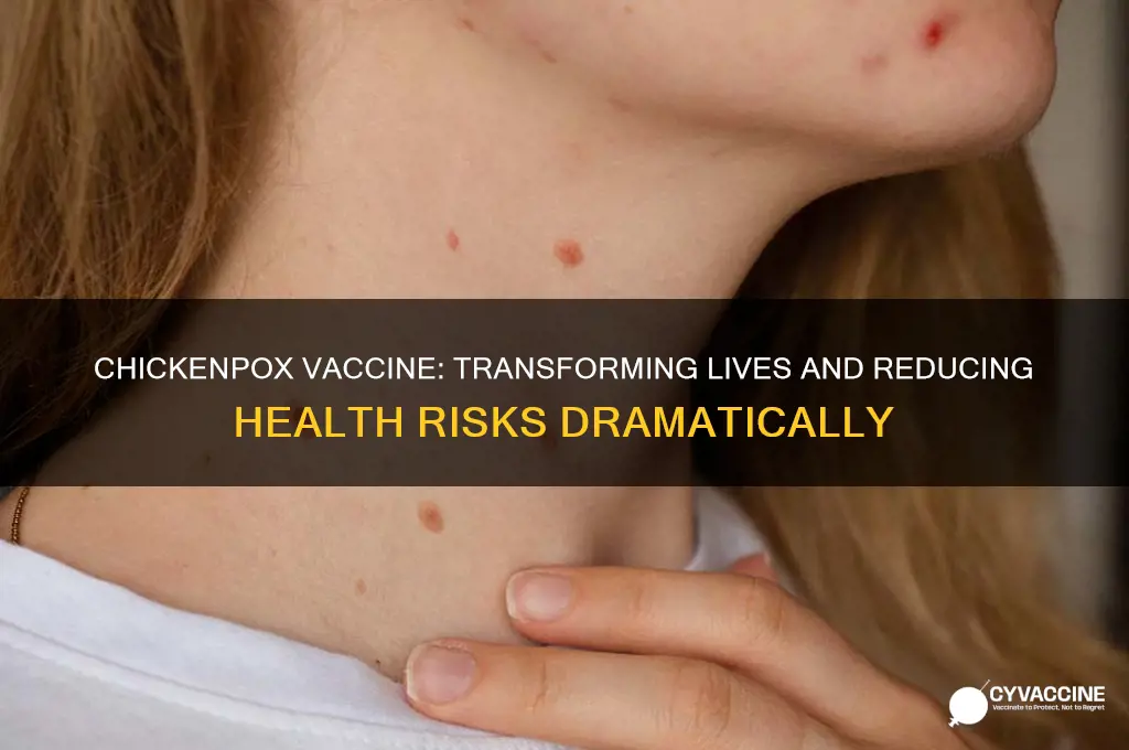 how has life improved since chickenpox vaccine been recommended