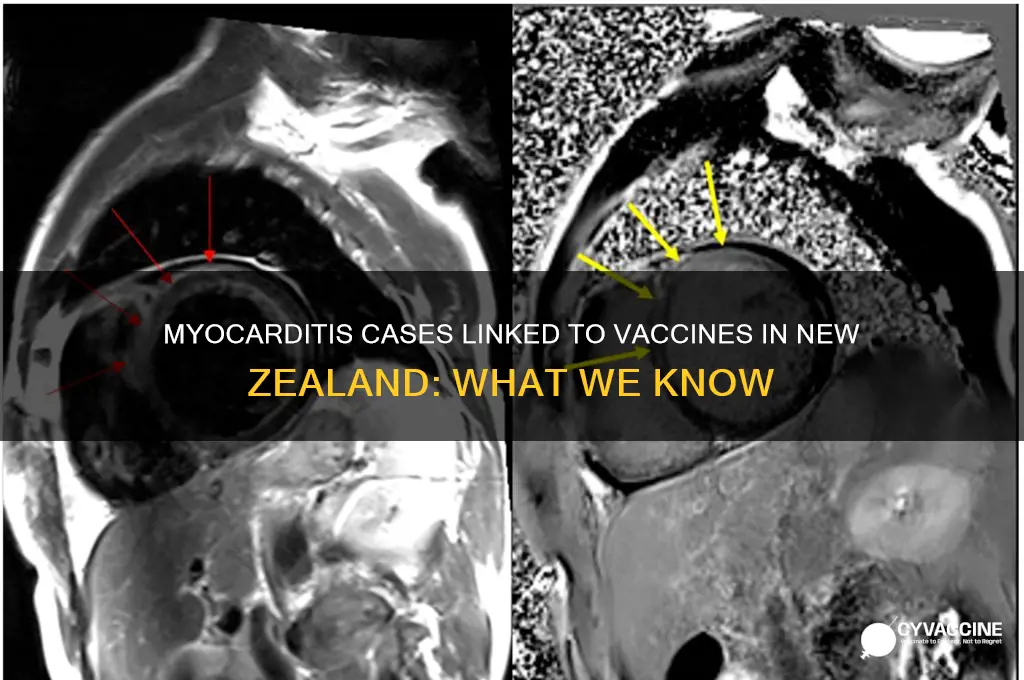 how many cases of myocarditis from vaccine in nz