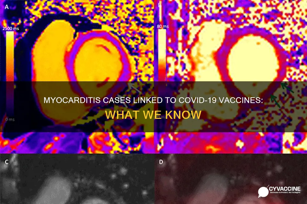 how many myocarditis cases from vaccine
