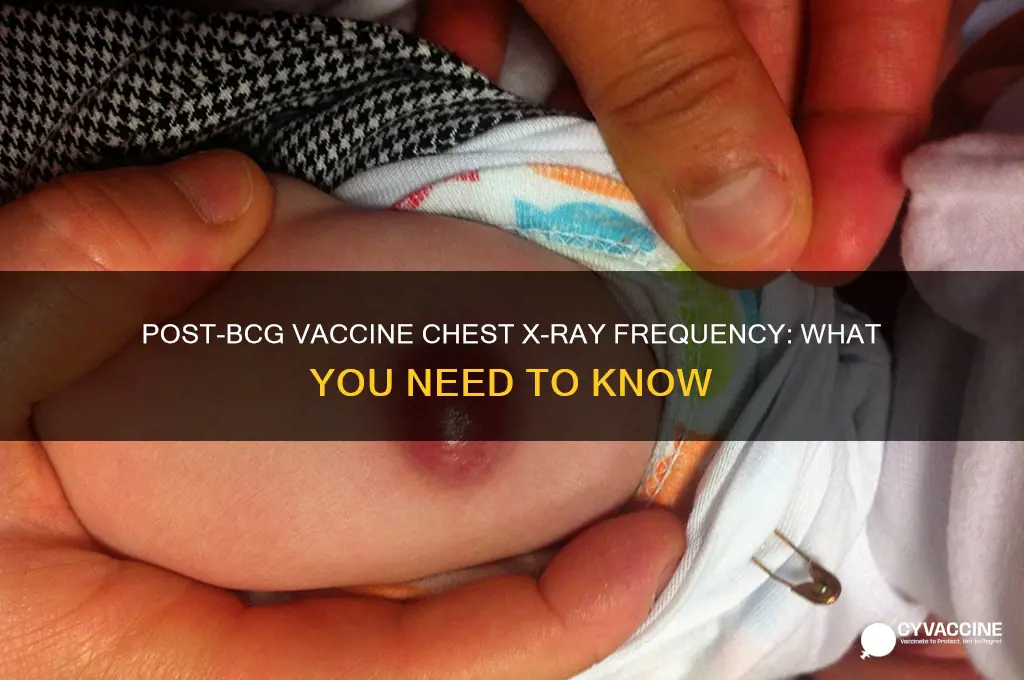 how often chest x-ray afer bcg vaccine