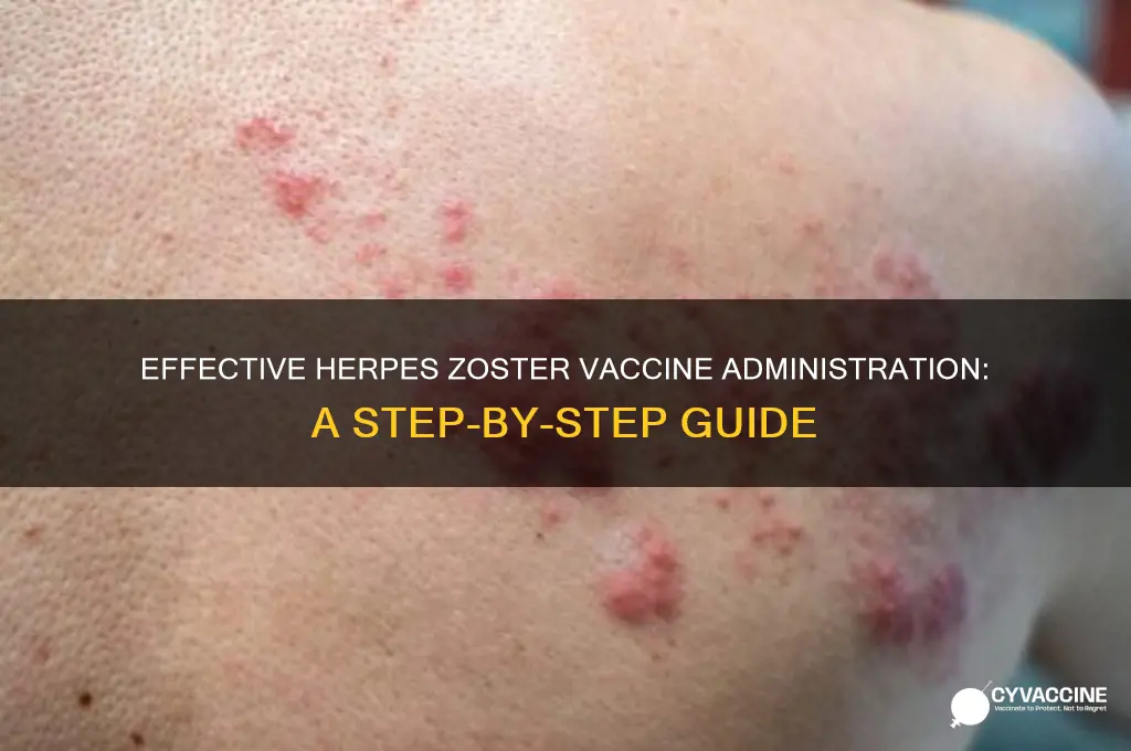 how to administer herpes zoster vaccine