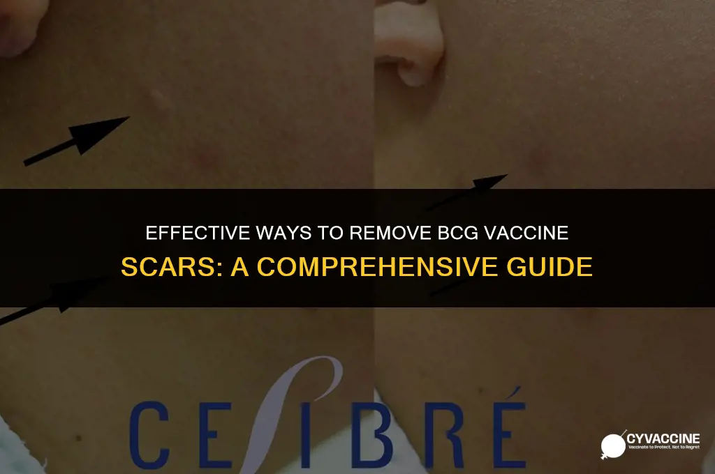 how to remove bcg vaccine scar