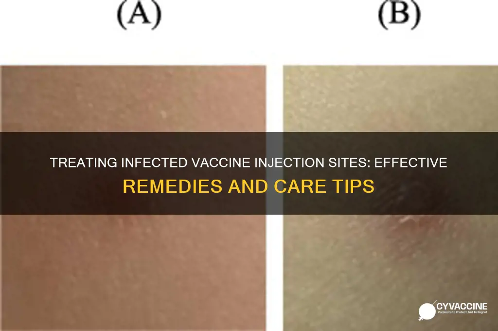 how to treat an infected vaccine injection site