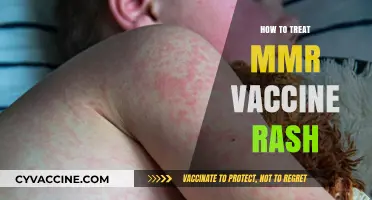 Soothing Solutions: How to Treat MMR Vaccine Rash Effectively