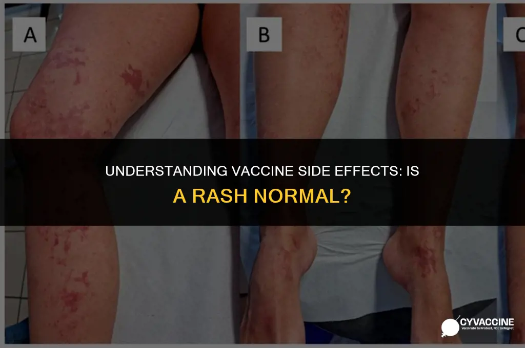 is a rash normal after vaccines