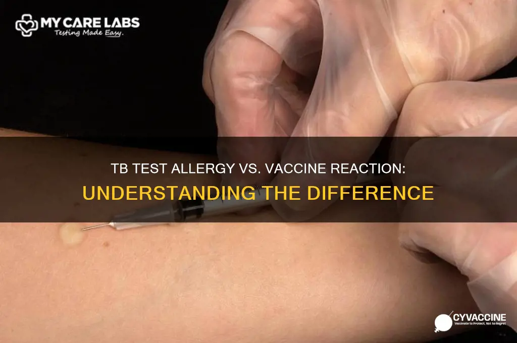 is allergy to tb test allergy to a vaccine