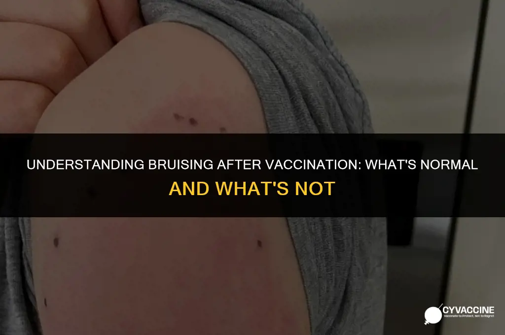 is bruising after a vaccine normal