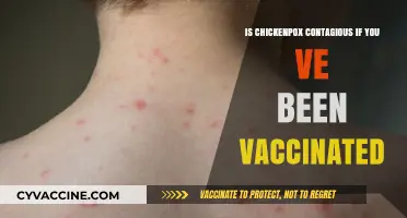 Vaccinated Against Chickenpox: Are You Still Contagious? Find Out Now