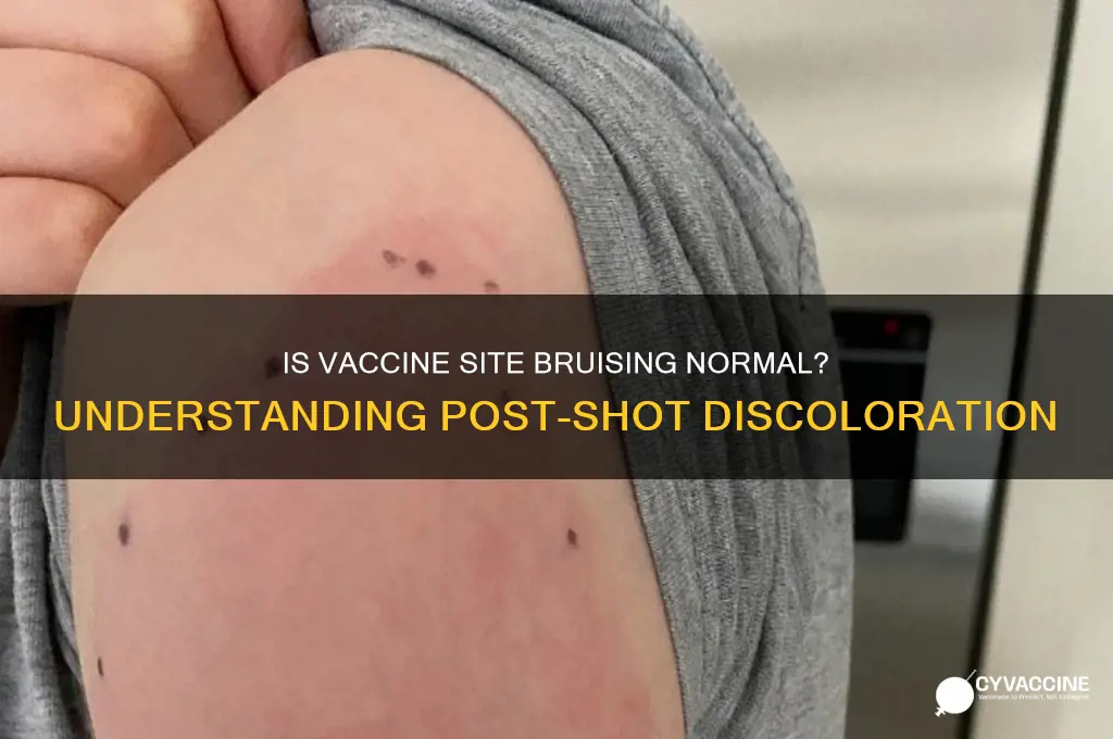 is it normal for vaccine site to bruise