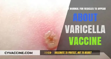 Varicella Vaccine Vesicles: Are Post-Vaccination Blisters Normal?