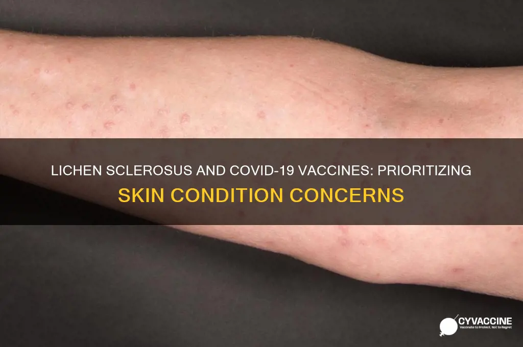 is lichen sclerosus a priority for a coronavirus vaccine