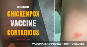 Debunking Myths: The Contagiousness of Chickenpox Vaccine Rash