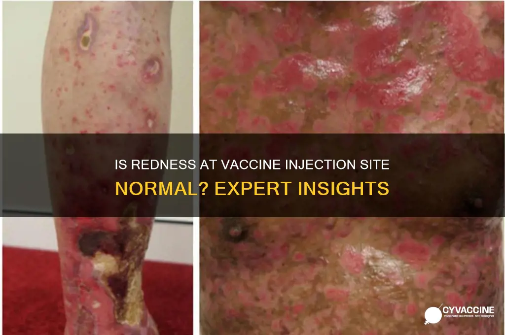 is redness at the injection site of a vaccine normal