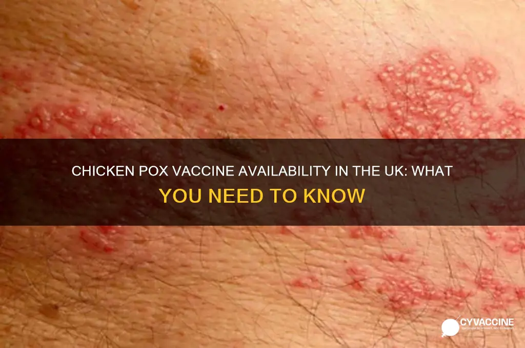 is the chicken pox vaccine available in the uk
