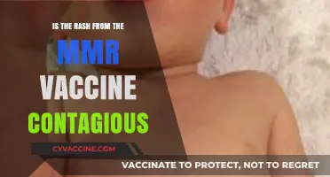 Is the MMR Vaccine Rash Contagious? Facts and Safety Explained