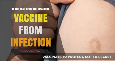 Smallpox Vaccine Scar: Infection or Immune Response Explained