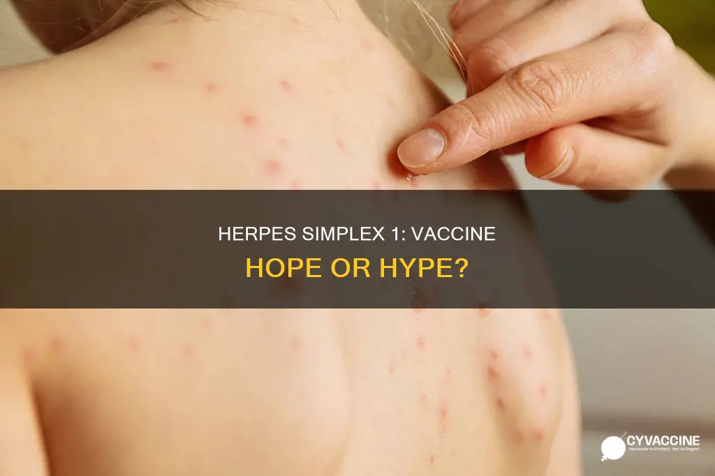 is there a vaccine for herpes simplex 1