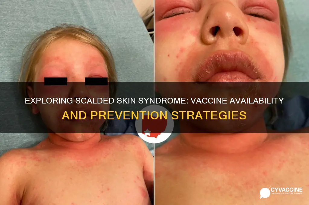 is there a vaccine for scalded skin syndrome