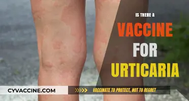Exploring Urticaria Treatments: The Vaccine Question Answered