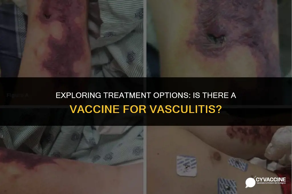 is there a vaccine for vasculitis