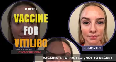 Exploring the Latest Research: Is There a Vaccine for Vitiligo?