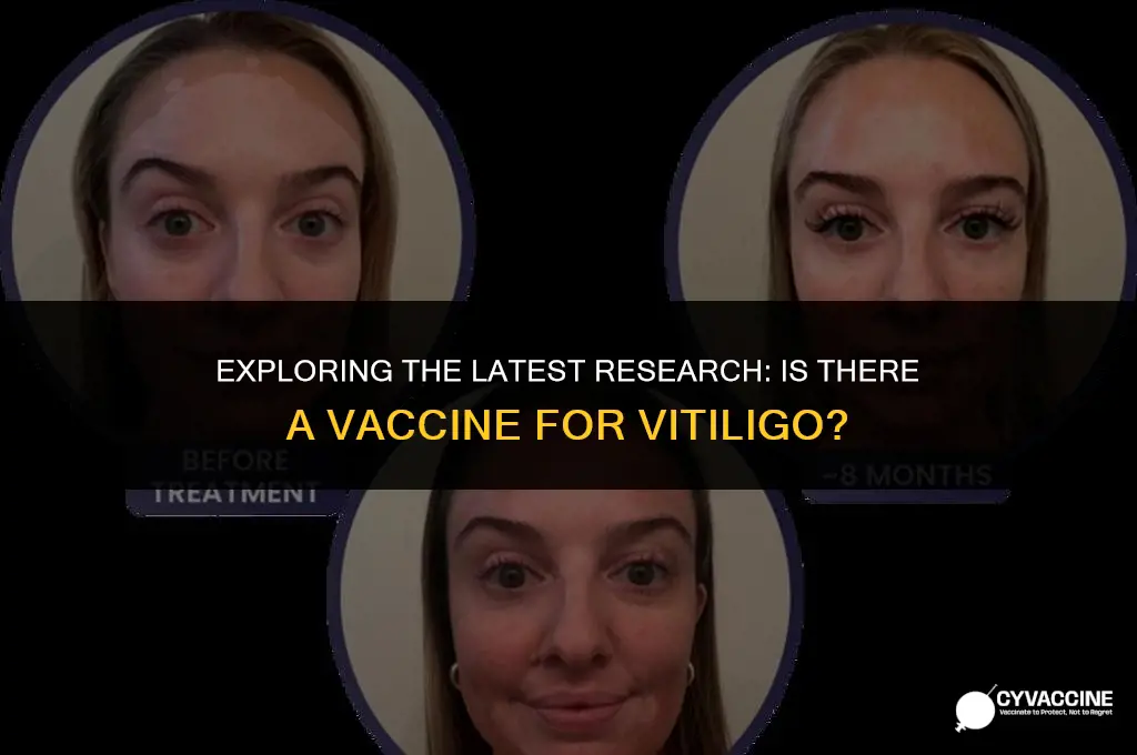 is there a vaccine for vitiligo