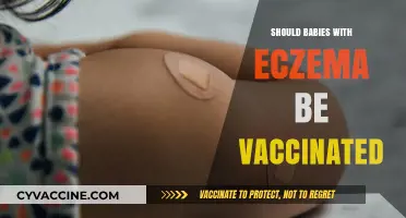 Vaccinating Babies with Eczema: Weighing the Benefits and Risks