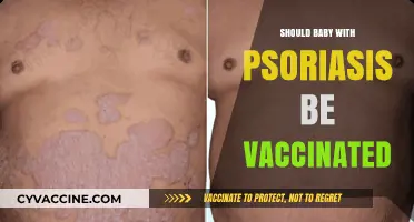 Vaccinating Babies with Psoriasis: Weighing Benefits and Risks