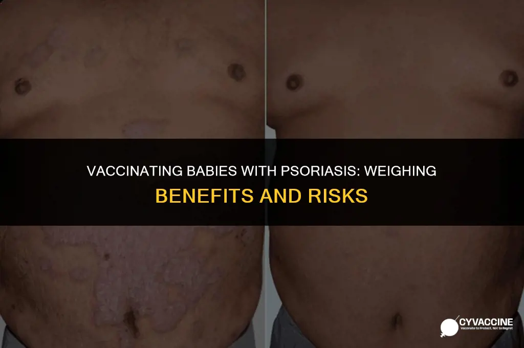should baby with psoriasis be vaccinated