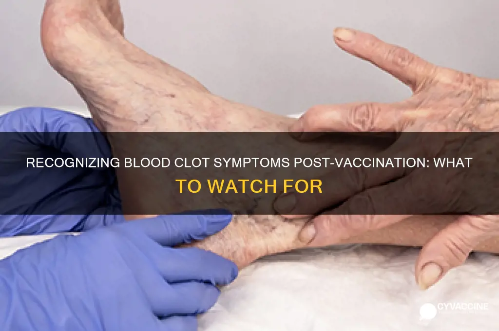 what are signs of blood clot after vaccine