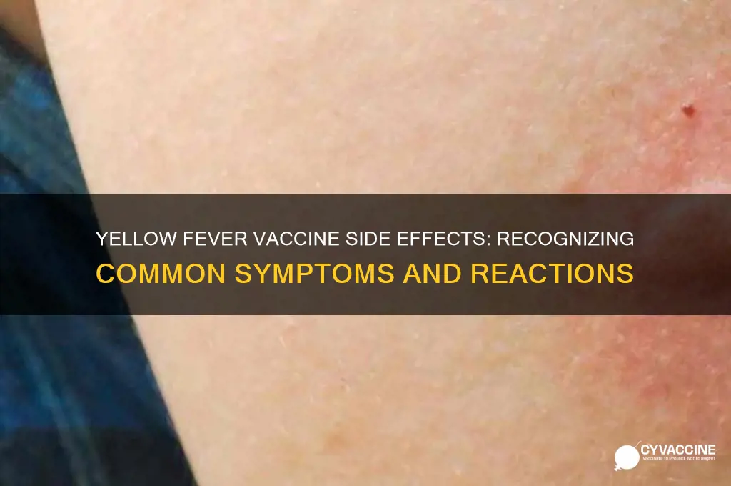 what are the symptoms of a yellow fever vaccine