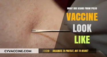 Polio Vaccine Scars: Understanding the Appearance and History
