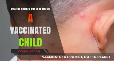 Vaccinated Chickenpox: Symptoms and Appearance in Immunized Children