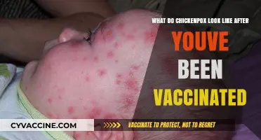 Vaccinated Chickenpox Appearance: What to Expect Post-Vaccination
