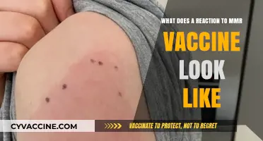 MMR Vaccine Reaction Symptoms: What to Expect and When to Worry