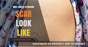 TB Vaccine Scar Appearance: What to Expect and How It Looks