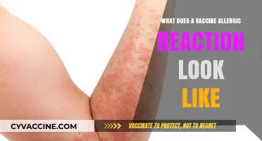 Vaccine Allergic Reactions: Signs and Symptoms Explained