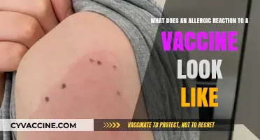 Recognizing Vaccine Allergic Reactions: Symptoms, Signs, and What to Expect
